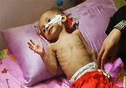 مرگ تدریجی میلیون‌‌ها کودک یمنی به دلیل جلوگیری عربستان از کمک رسانی + فیلم