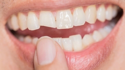 نکاتی در مورد سفید کردن دندان + فیلم